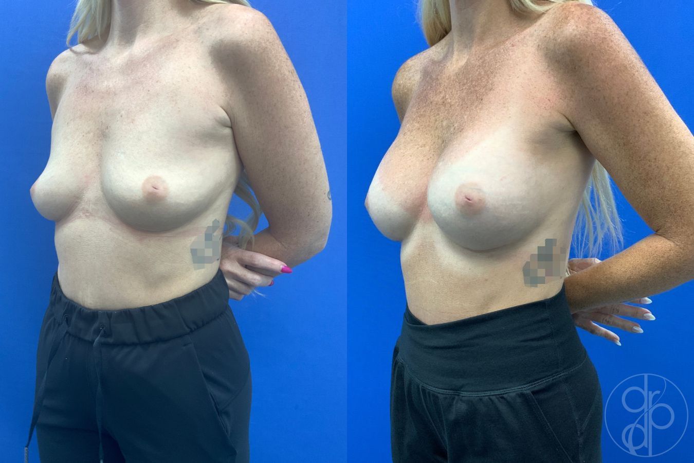 Before and after Breast Augmentation case 46357 - Angle 4