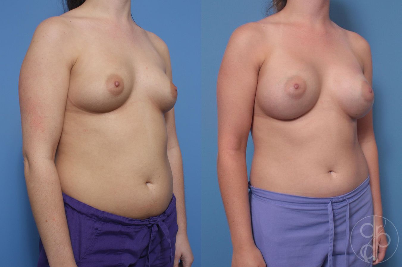 Breast Augmentation - Thumbnail 4