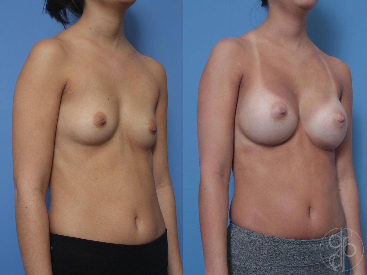 Before and after Breast Augmentation case 29815 - Angle 3