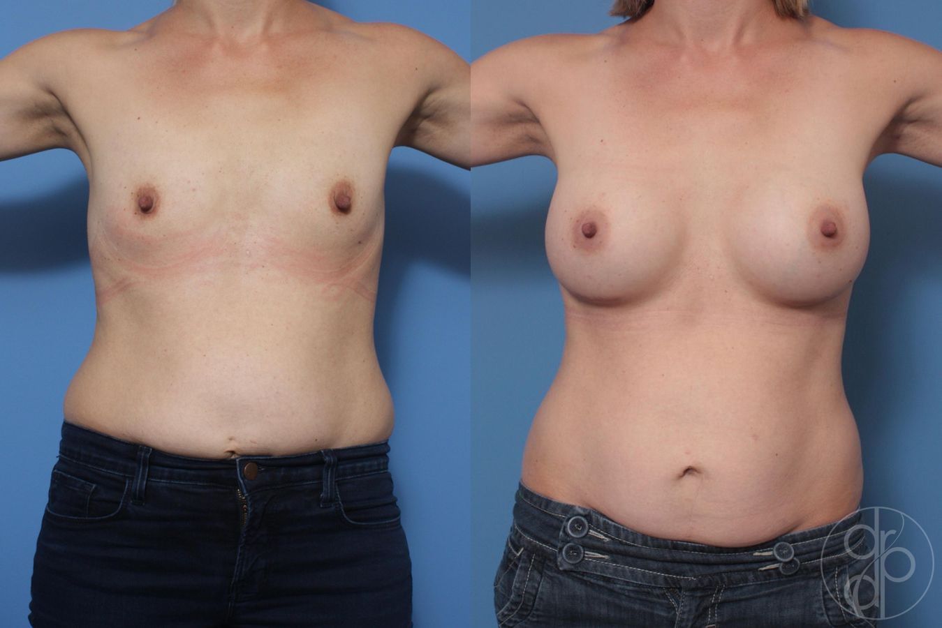 Before and after Breast Augmentation case 29644 - Angle 2