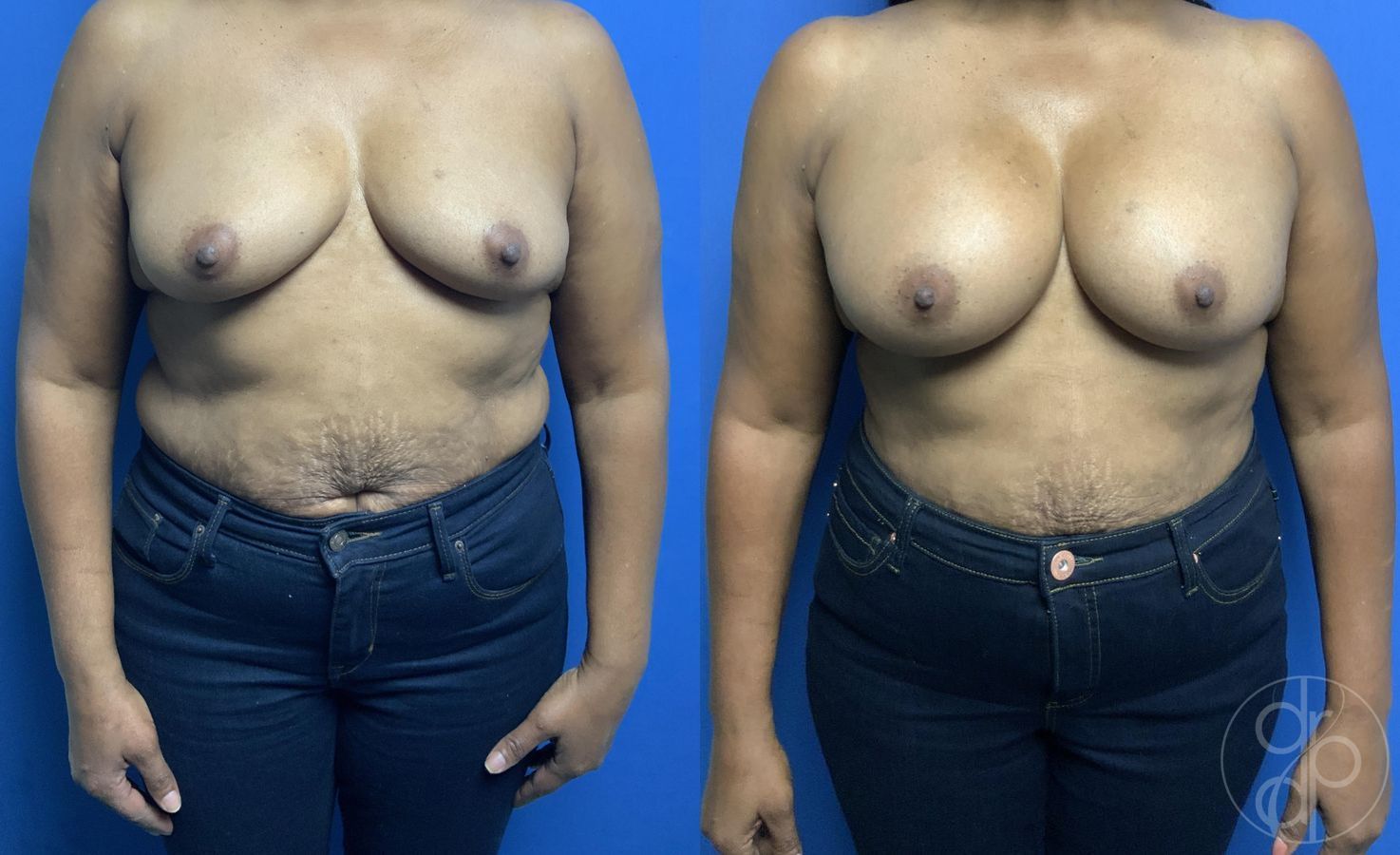 Before and after Breast Augmentation case 29786