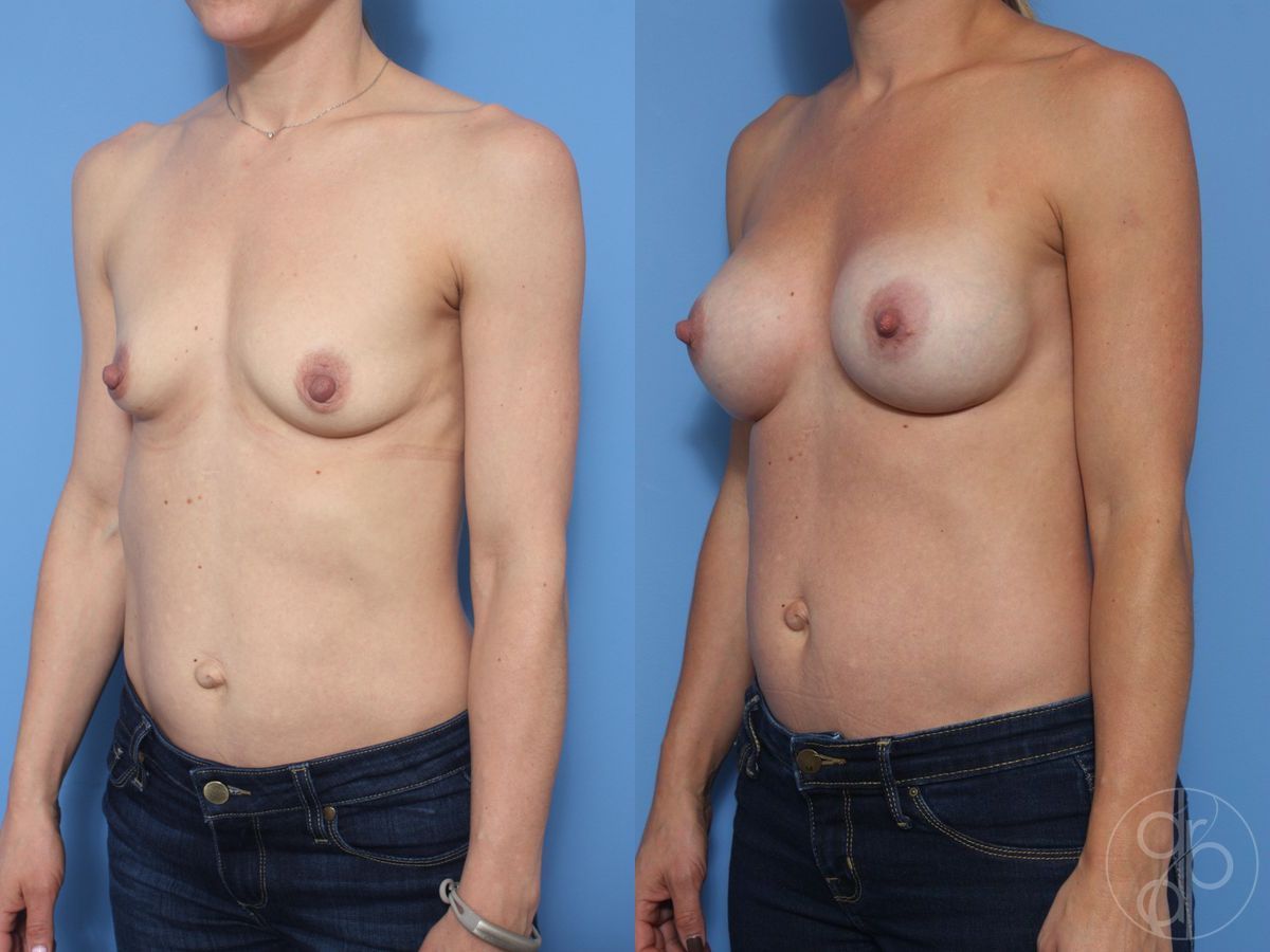Before and after Breast Augmentation case 29822 - Angle 3