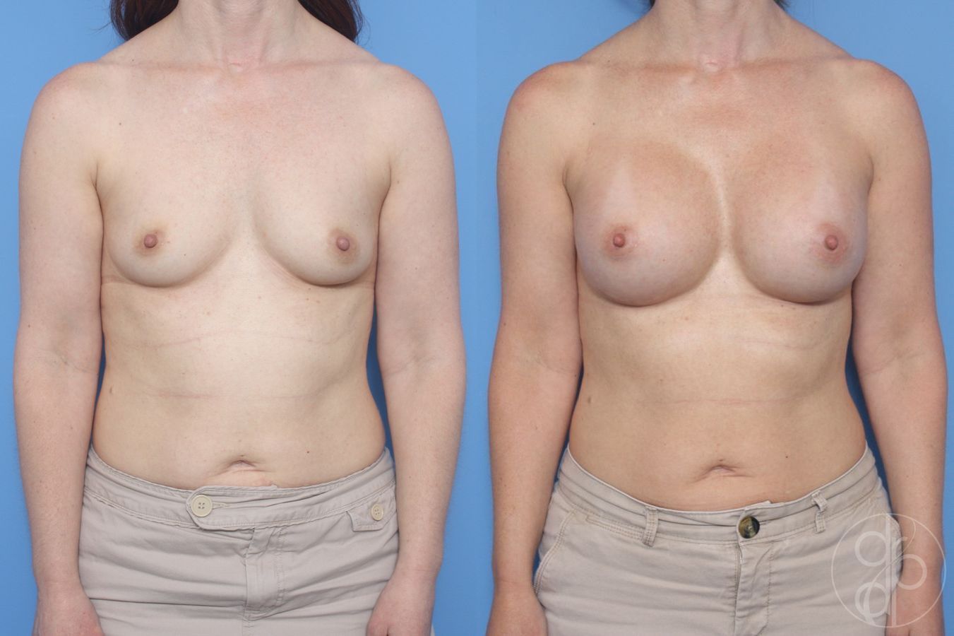 Before and after Breast Augmentation case 29945