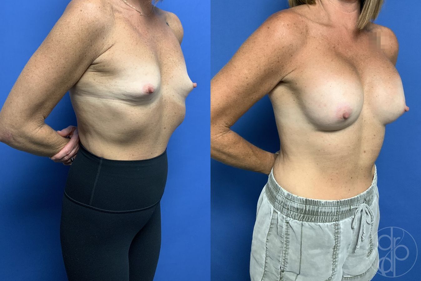 Before and after Breast Augmentation case 29838 - Angle 2