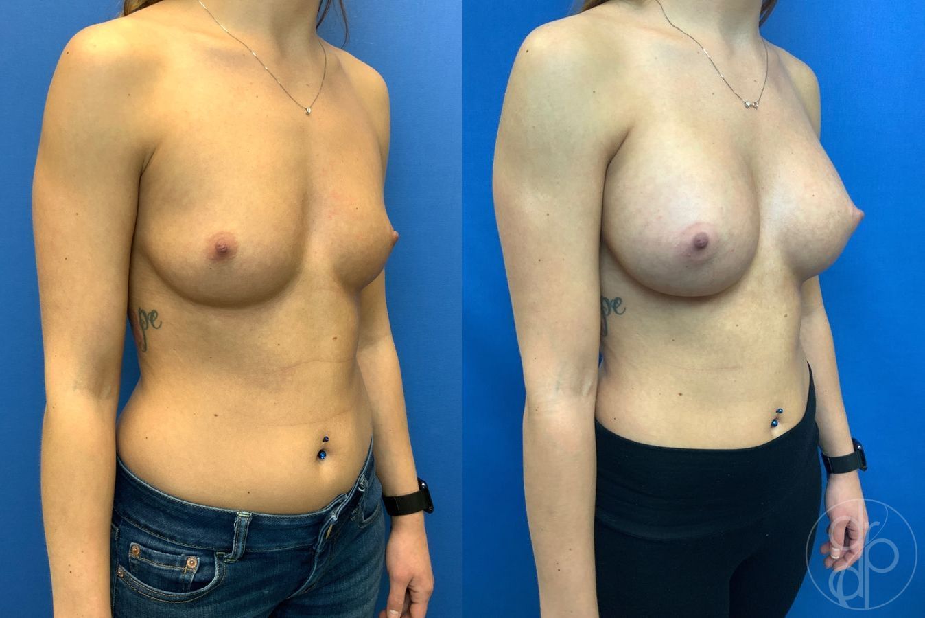 Before and after Breast Augmentation case 29943 - Angle 2