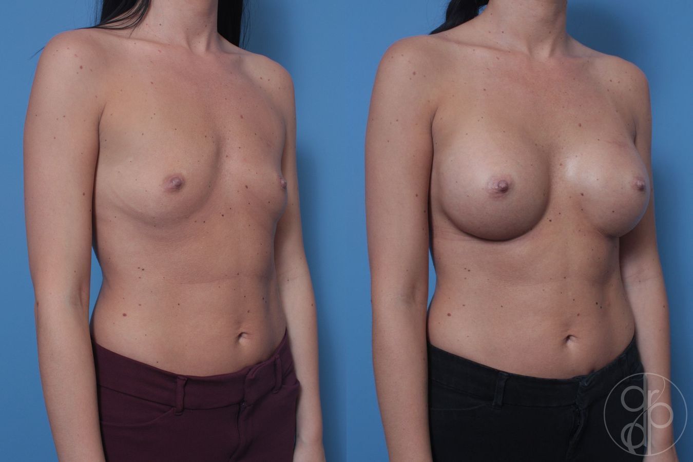 Breast Augmentation - Thumbnail 2