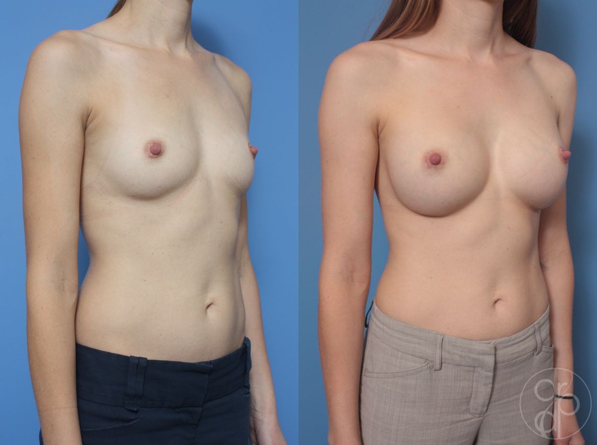 Before and after Breast Augmentation case 29909 - Angle 2