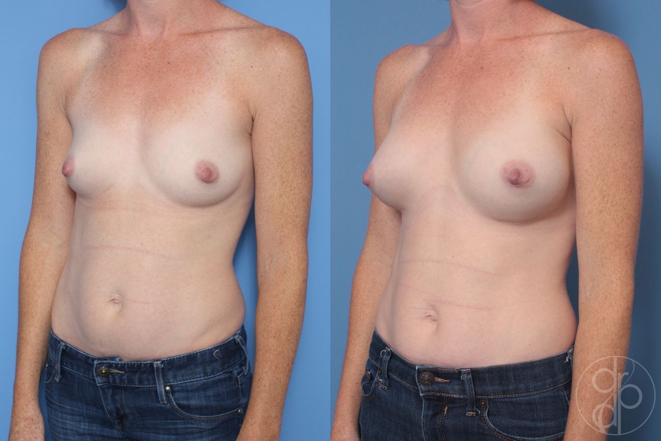 Before and after Breast Augmentation case 29936 - Angle 3
