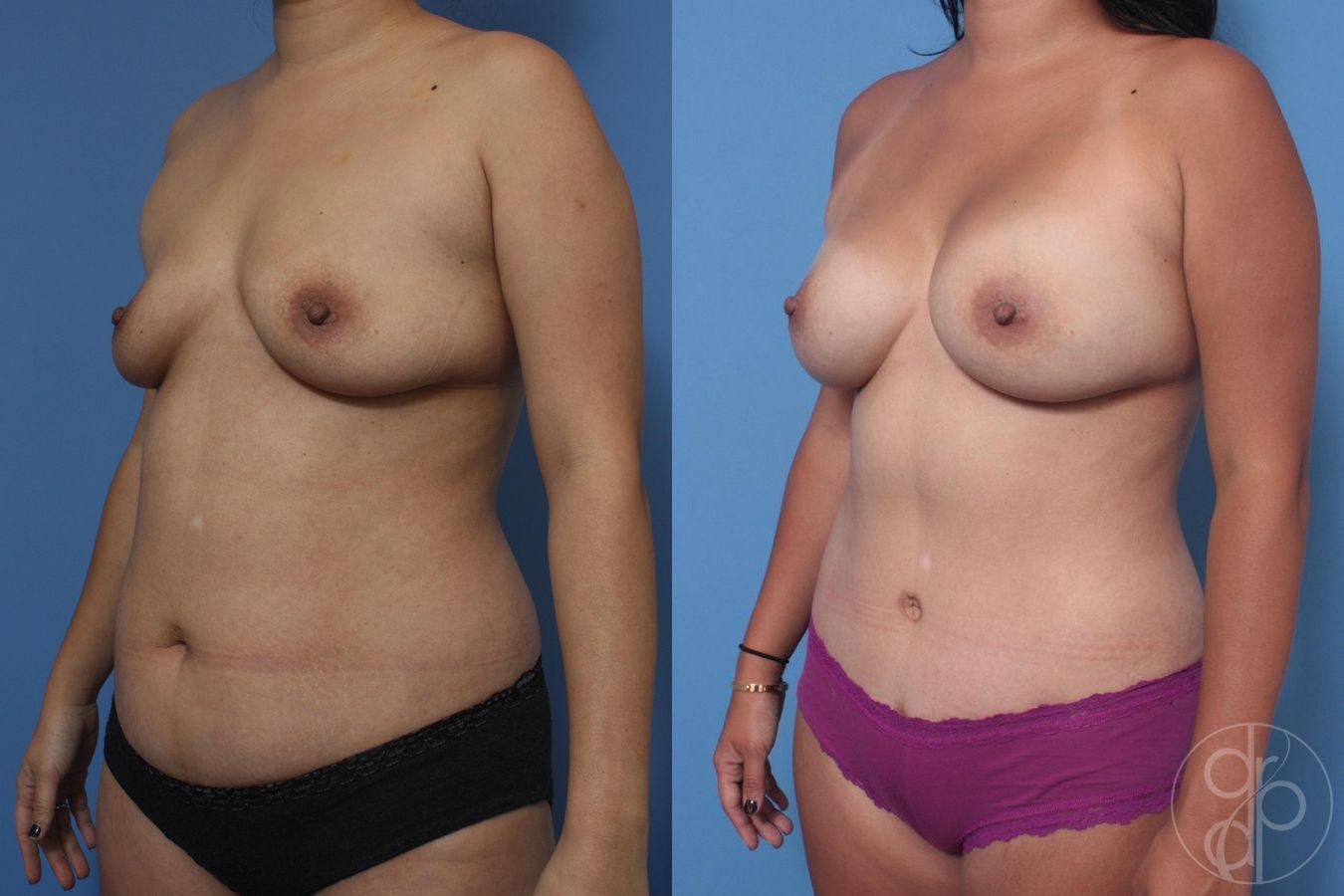 Before and after Breast Augmentation case 29715 - Angle 4