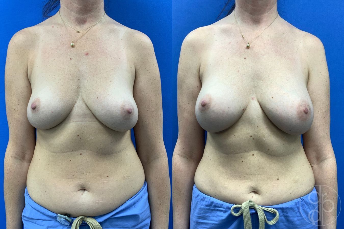 Before and after Breast Augmentation case 43190