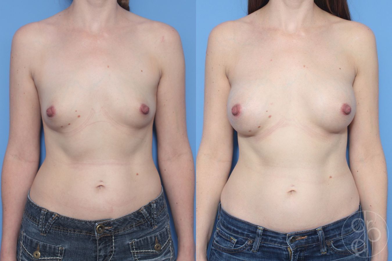 Before and after Breast Augmentation case 29950
