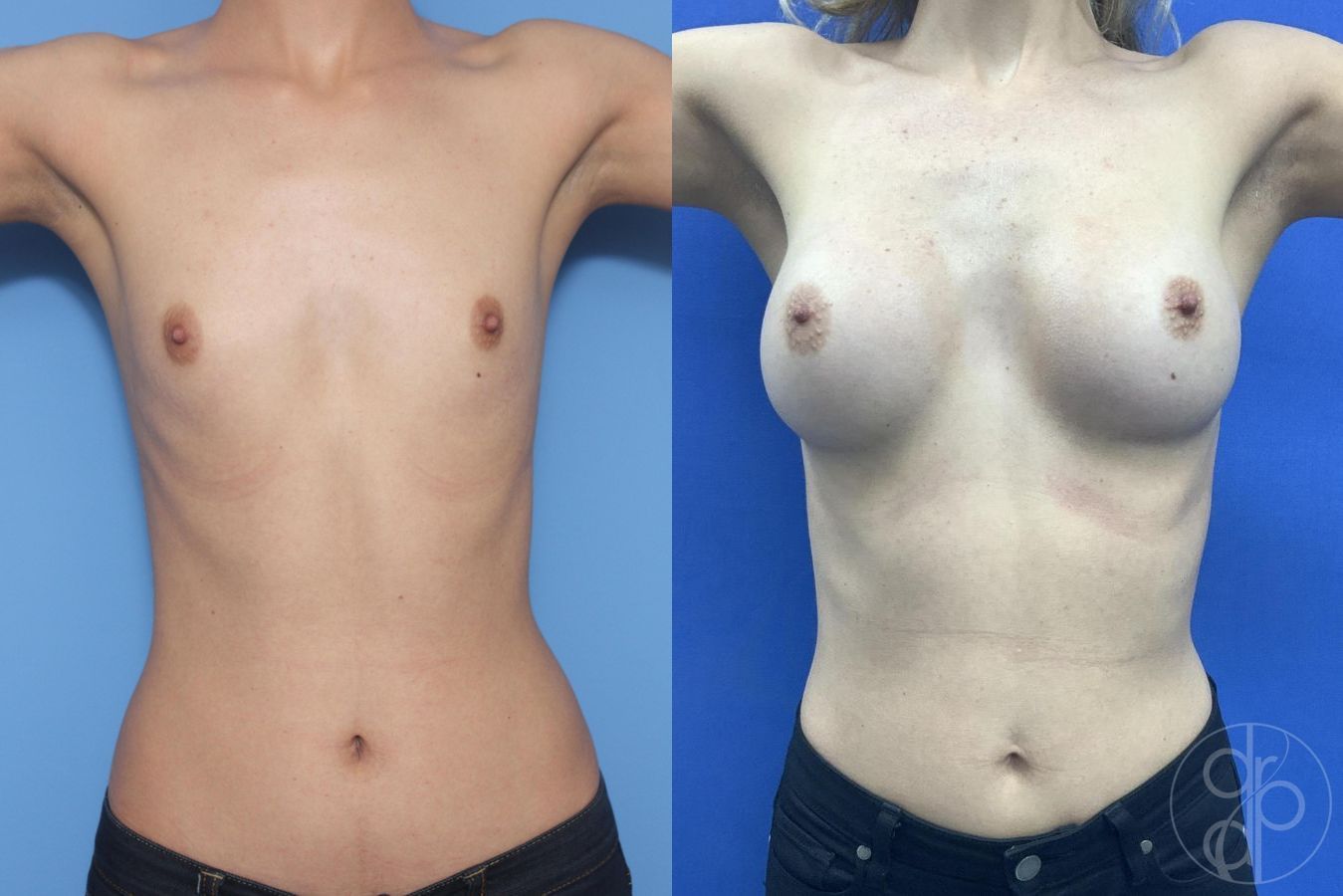 Before and after Breast Augmentation case 29935 - Angle 2