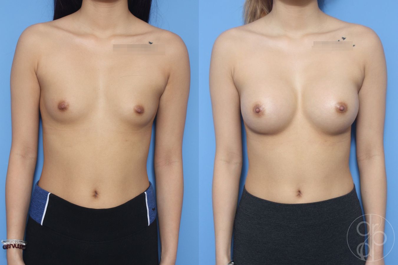Before and after Breast Augmentation case 29940