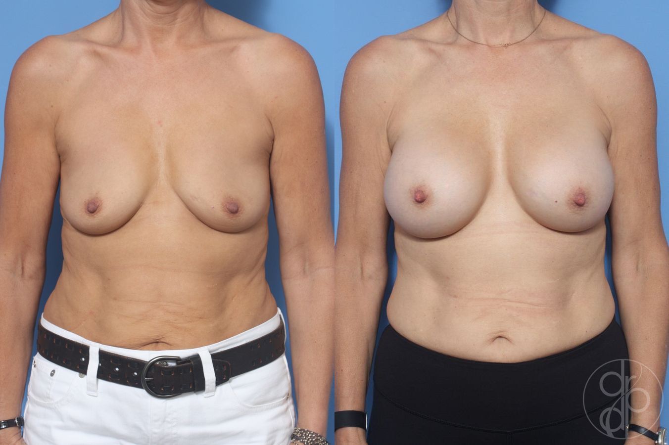 Before and after Breast Augmentation case 29955
