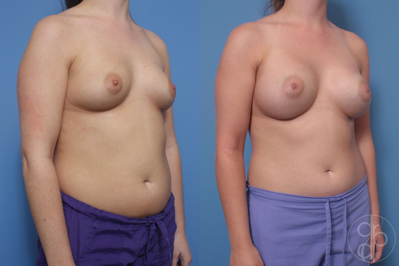 Before and after Breast Augmentation case 29821 - Angle 4