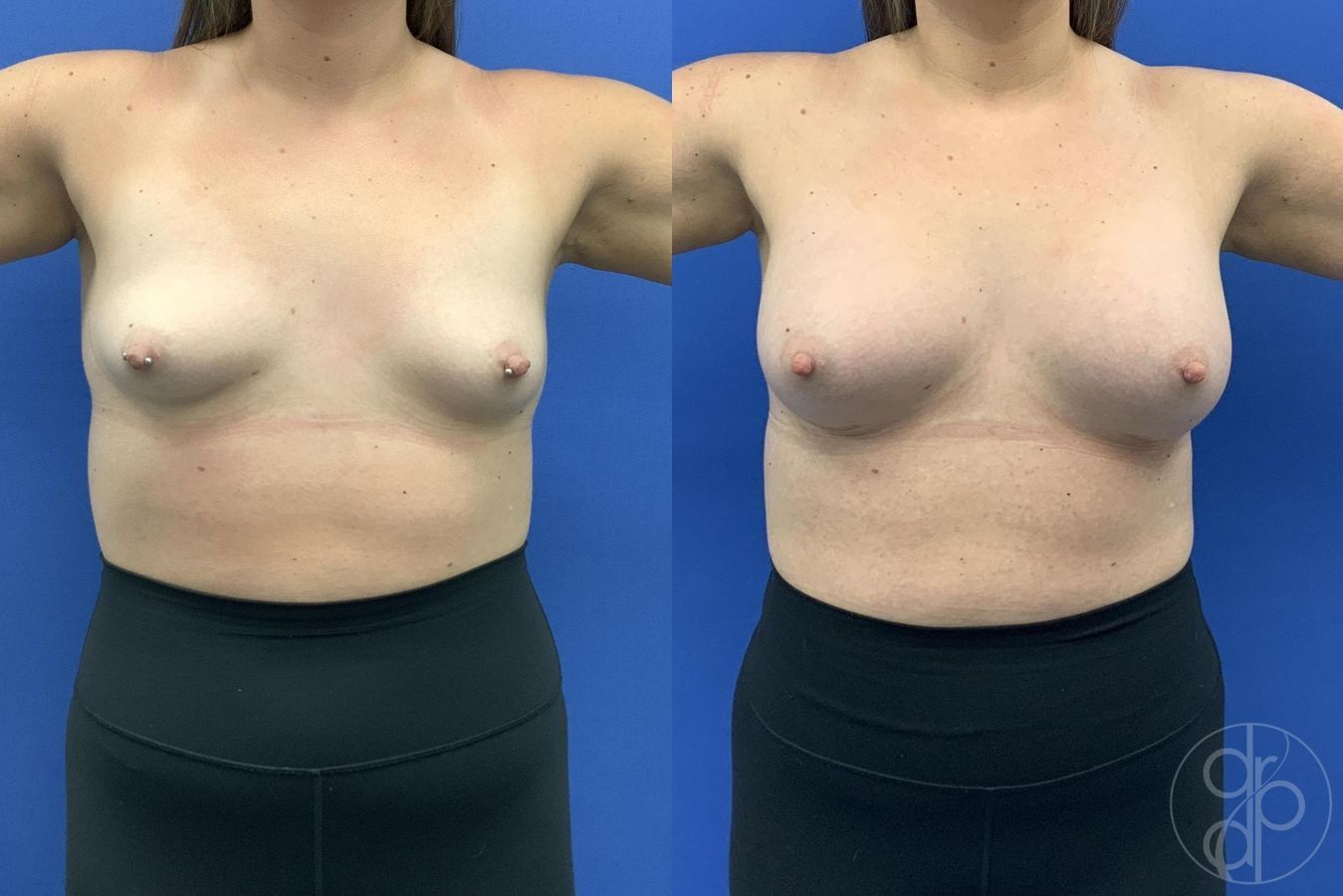 Before and after Breast Augmentation case 30024 - Angle 2