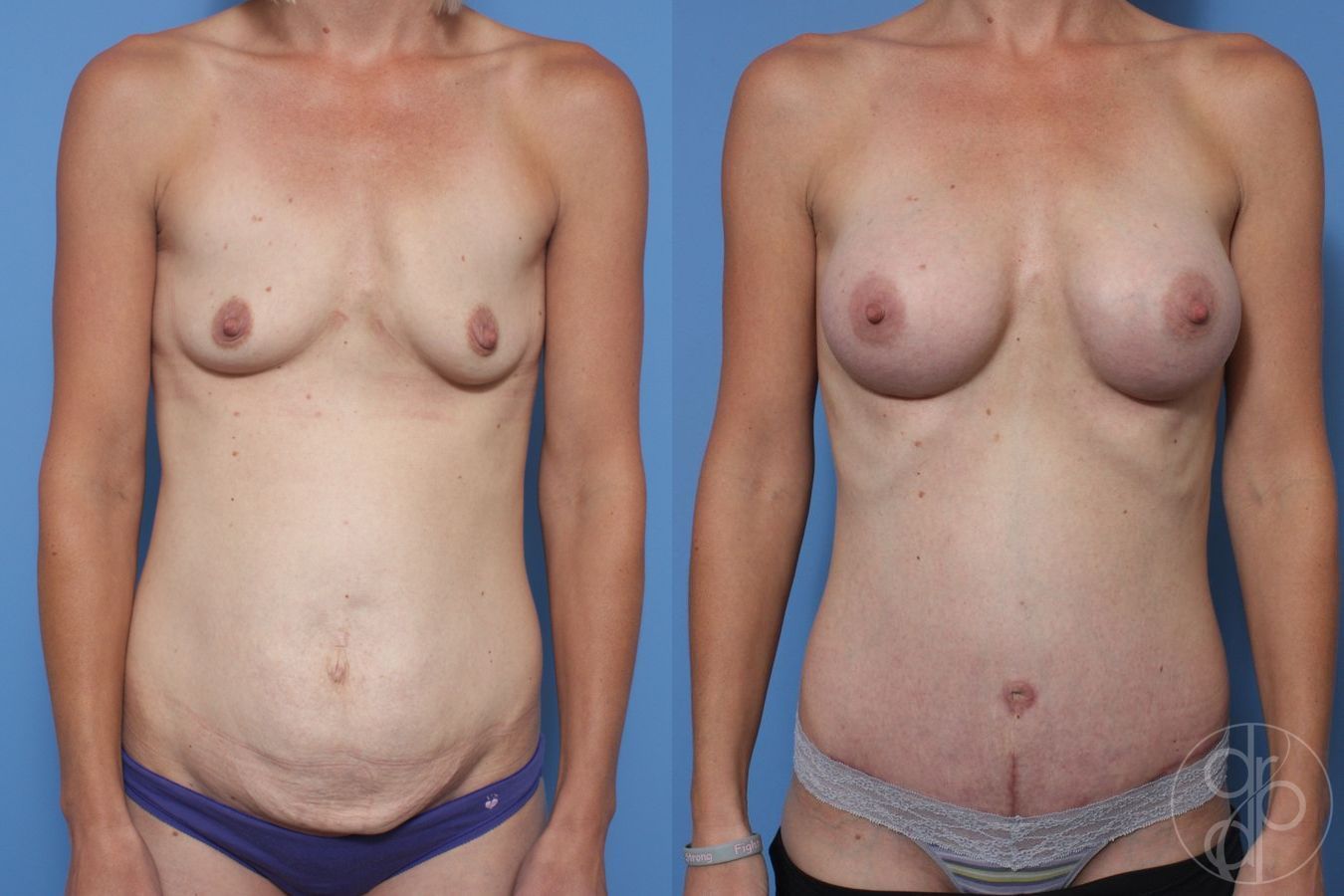 Before and after Breast Augmentation case 29722