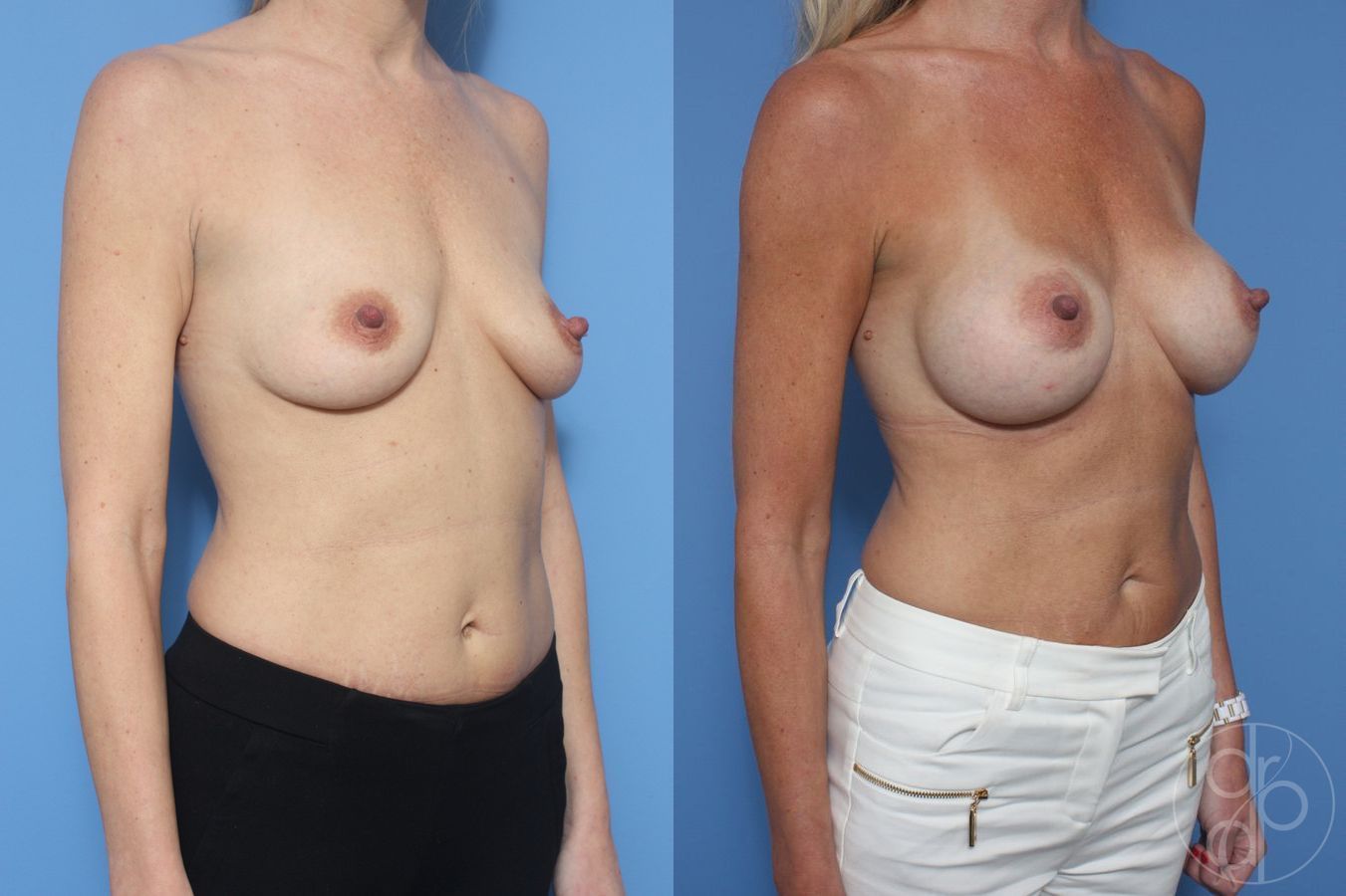 Before and after Breast Augmentation case 29938 - Angle 2
