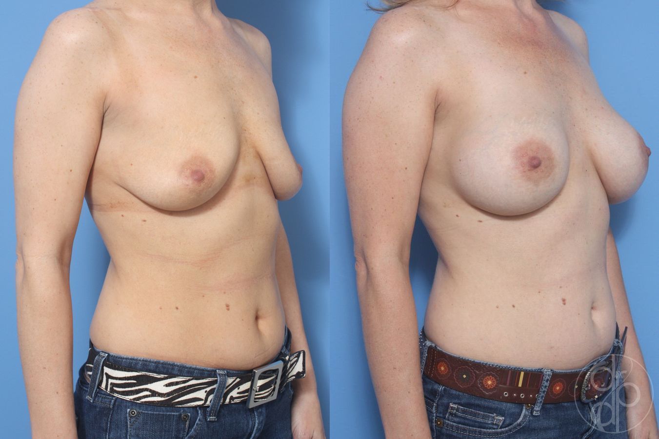 Before and after Breast Augmentation case 29932 - Angle 2