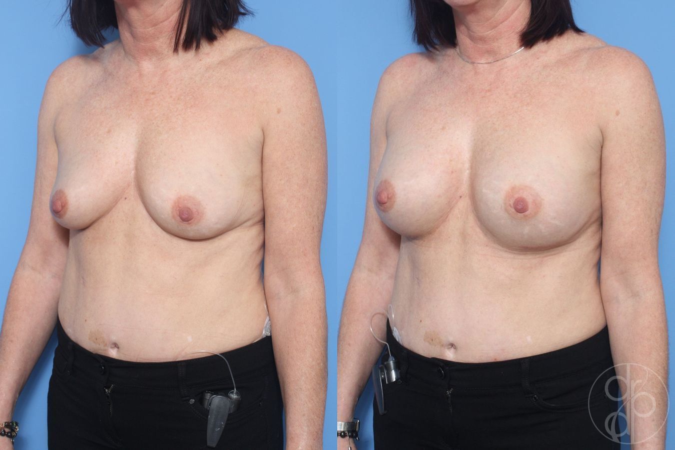 Before and after Breast Augmentation case 29905 - Angle 2