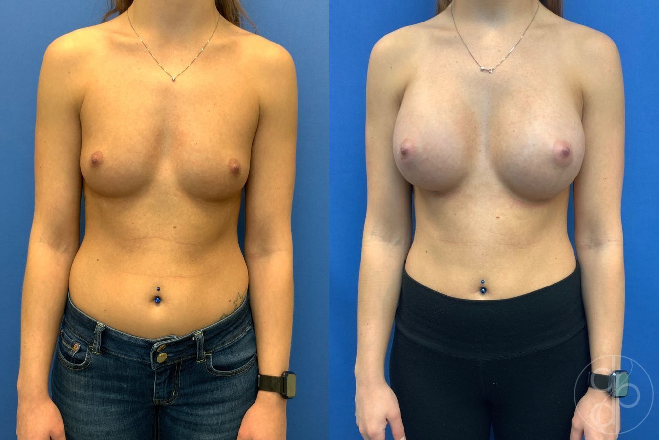 Before and after Breast Augmentation case 29943