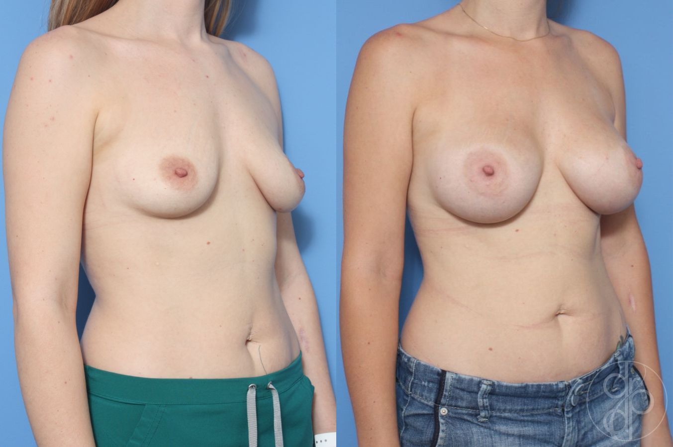 Before and after Breast Augmentation case 29930 - Angle 2
