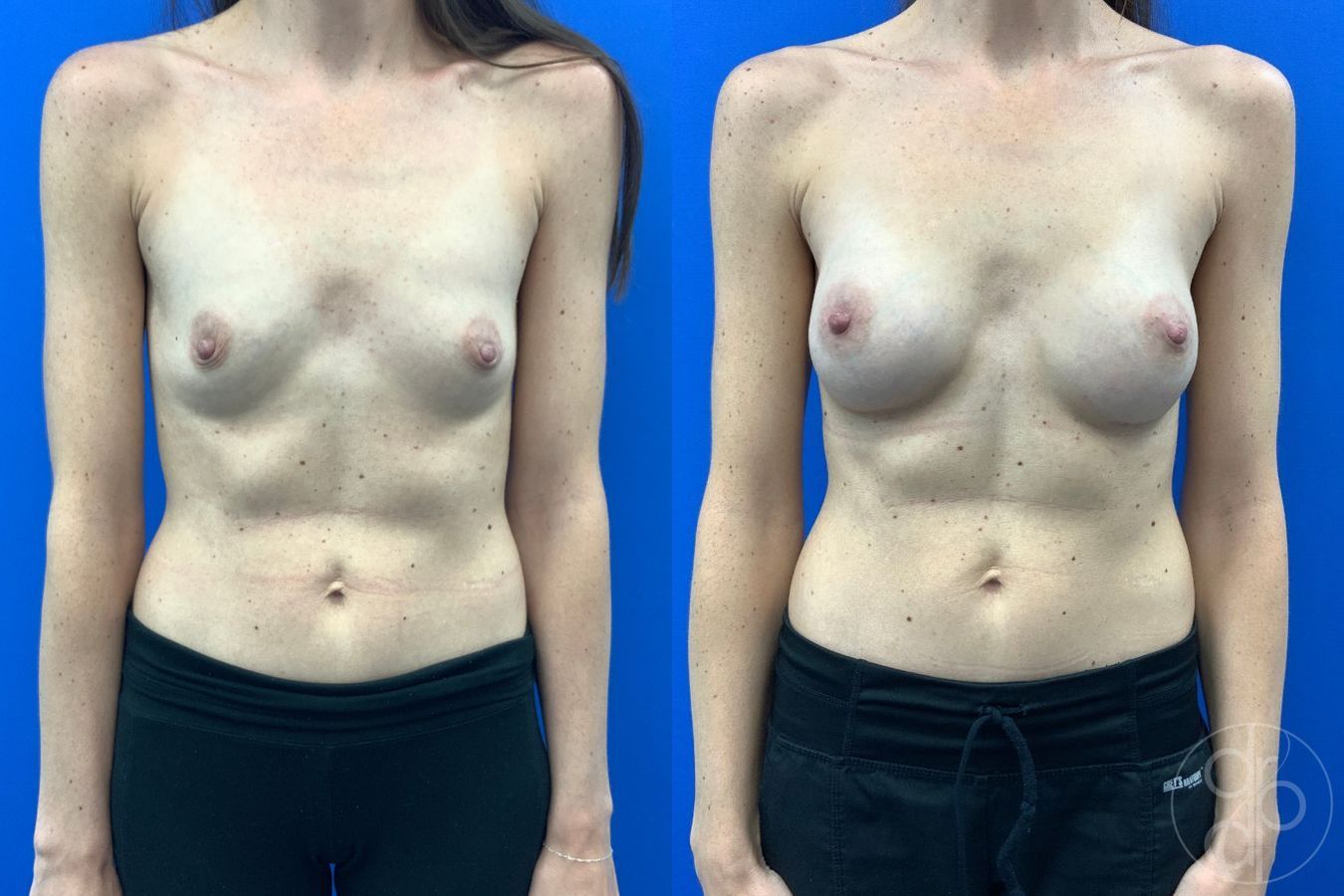 Before and after Breast Augmentation case 43474