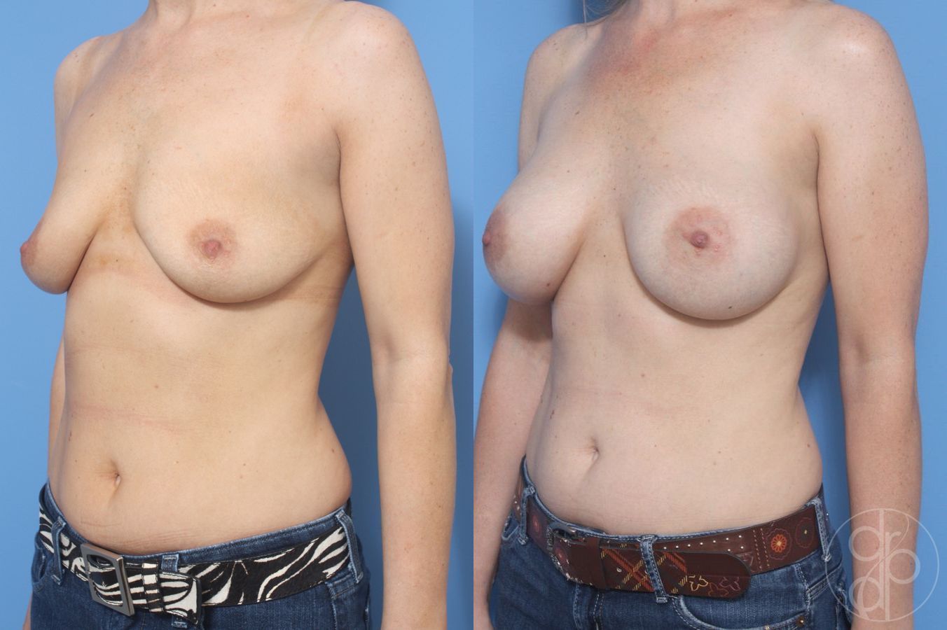 Before and after Breast Augmentation case 29932 - Angle 3