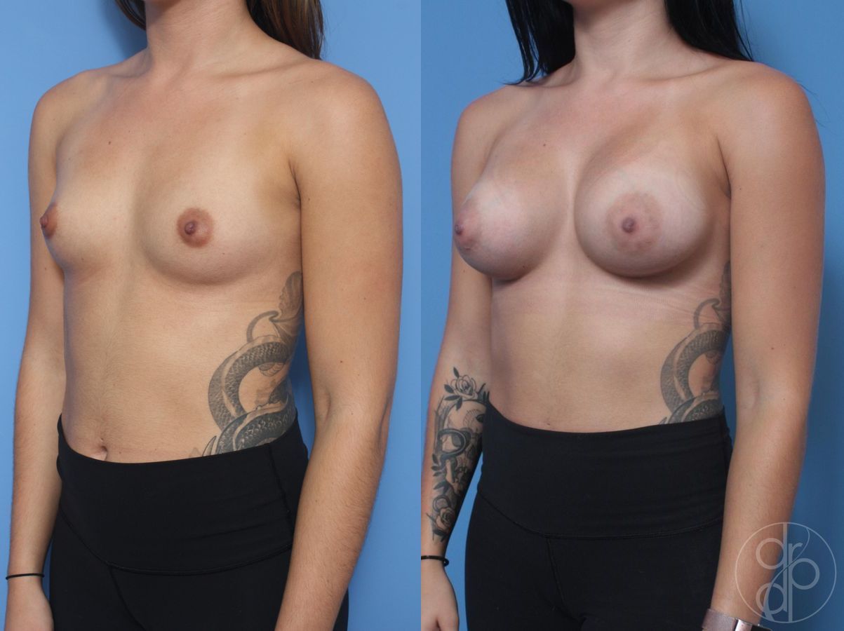 Before and after Breast Augmentation case 29819 - Angle 3
