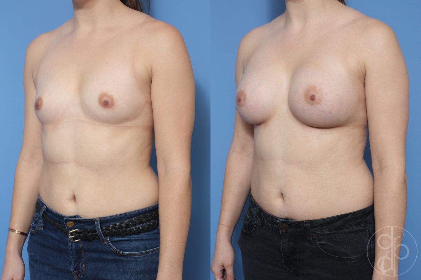 Before and after Breast Augmentation case 29953 - Angle 3