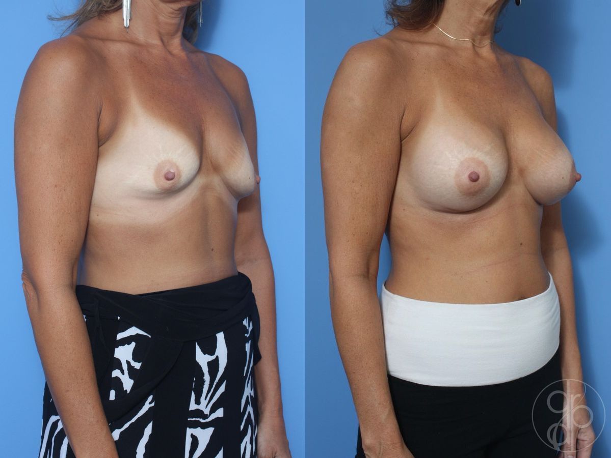 Before and after Breast Augmentation case 29823 - Angle 3
