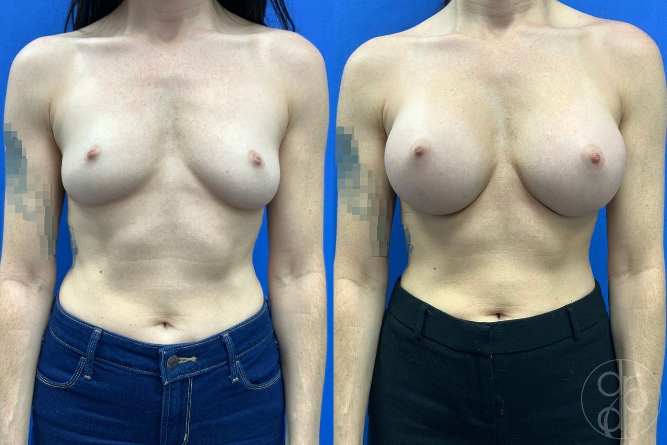 Before and after Breast Augmentation case 43194