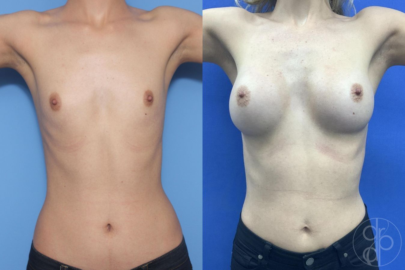 Before and after Breast Augmentation case 29935 - Angle 2