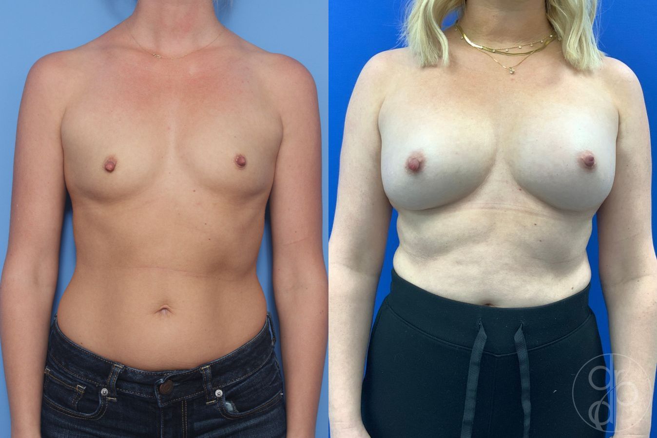Before and after Breast Augmentation case 46257