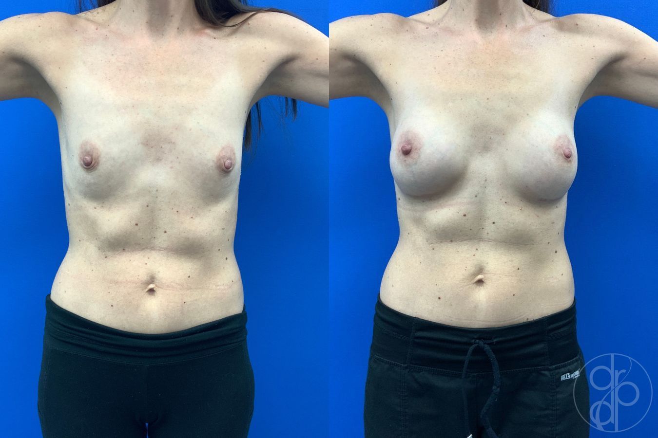 Before and after Breast Augmentation case 43474 - Angle 2