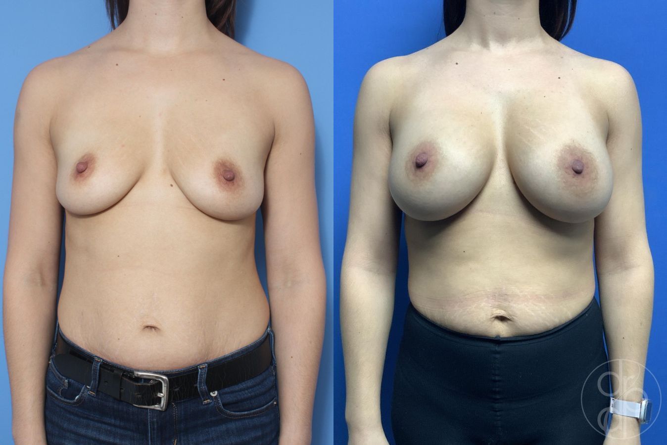 Before and after Breast Augmentation case 29817