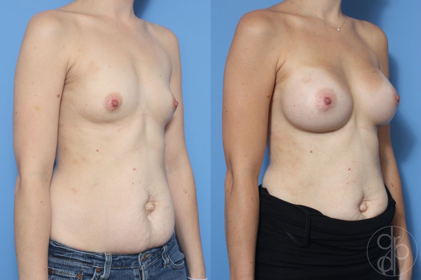 Before and after Breast Augmentation case 29961 - Angle 2