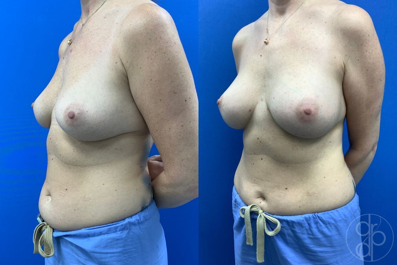 Before and after Breast Augmentation case 43190 - Angle 4