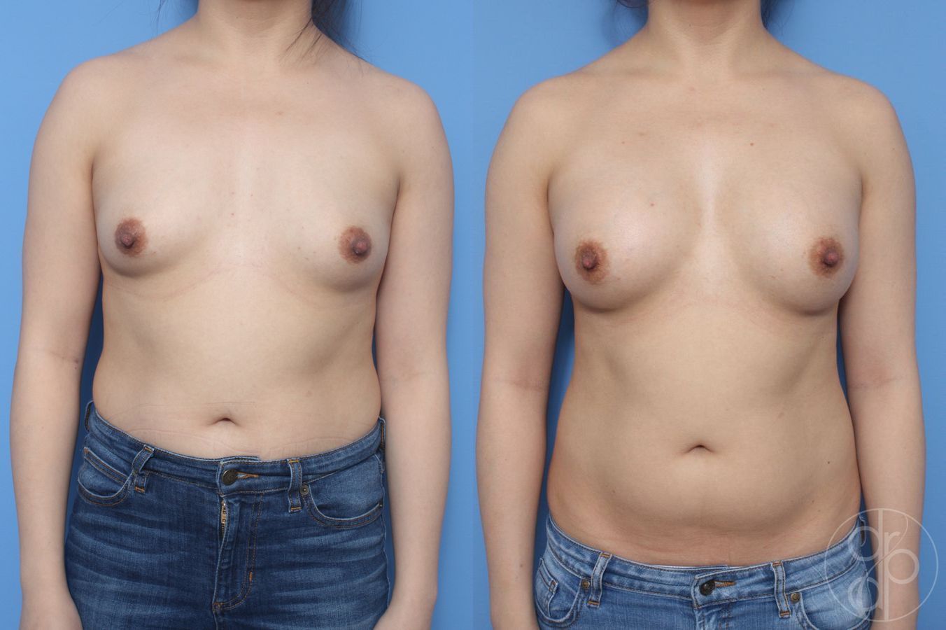 Before and after Breast Augmentation case 29910