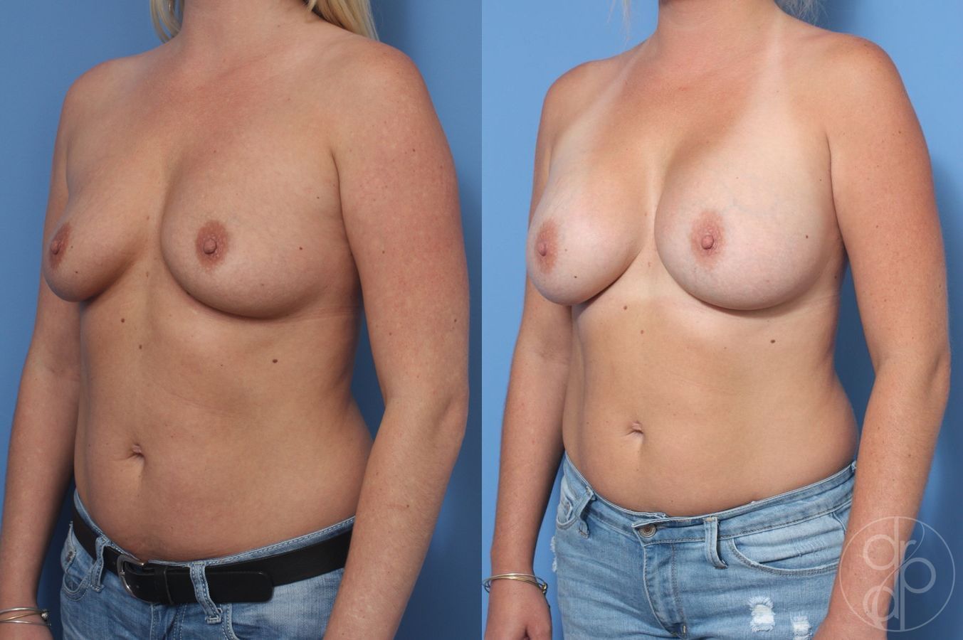 Before and after Breast Augmentation case 29957 - Angle 3