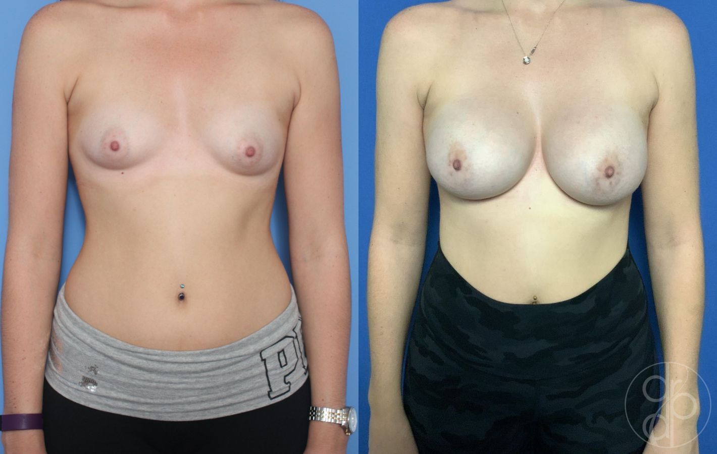Before and after Breast Augmentation case 29787