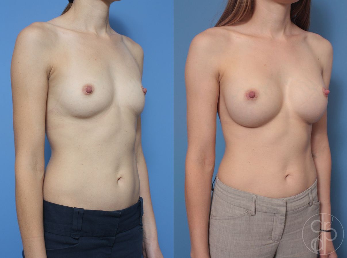 Before and after Breast Augmentation case 29909 - Angle 2