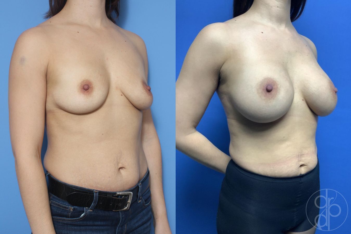 Before and after Breast Augmentation case 29817 - Angle 2
