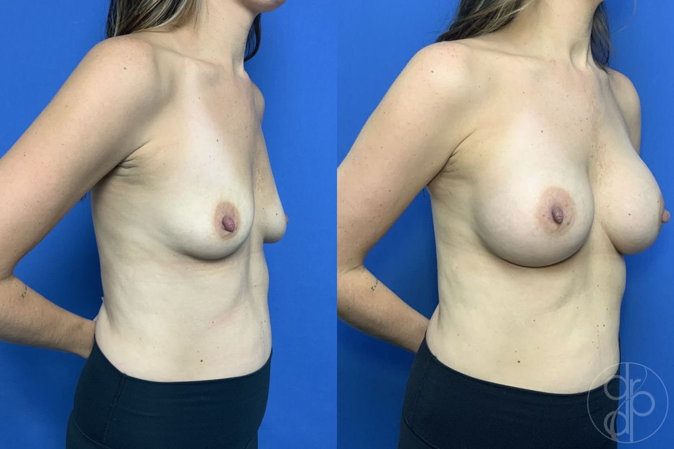 Before and after Breast Augmentation case 29896 - Angle 2
