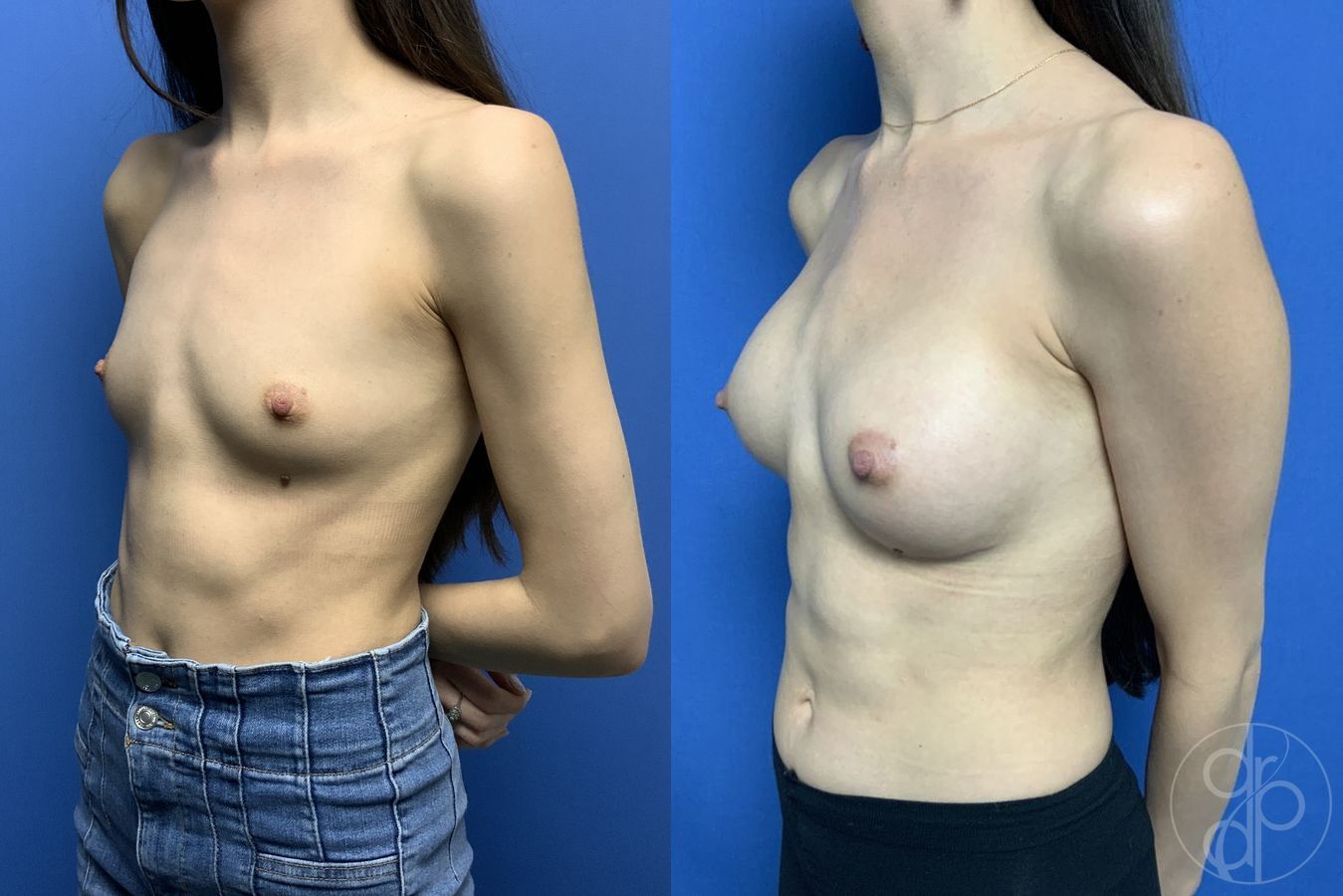 Before and after Breast Augmentation case 29836 - Angle 3