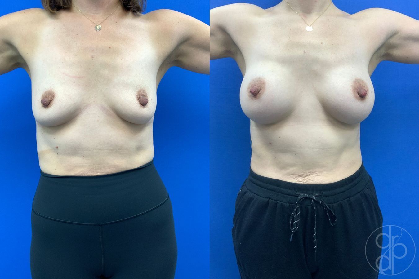 Before and after Breast Augmentation case 46262 - Angle 2