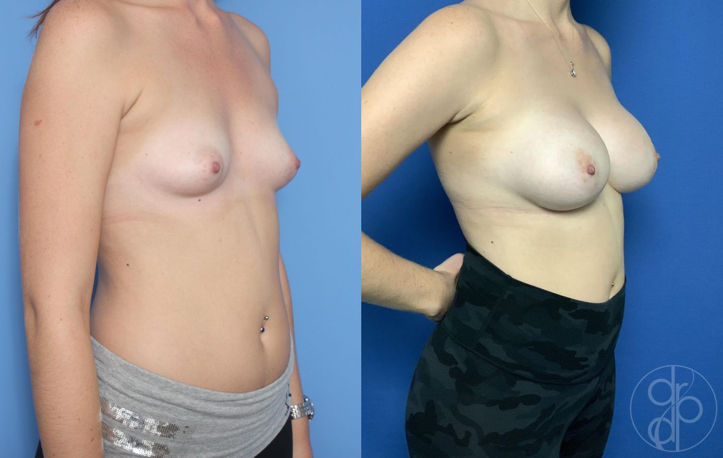 Before and after Breast Augmentation case 29787 - Angle 2