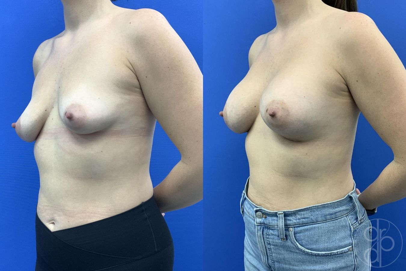 Before and after Breast Augmentation case 29655 - Angle 3