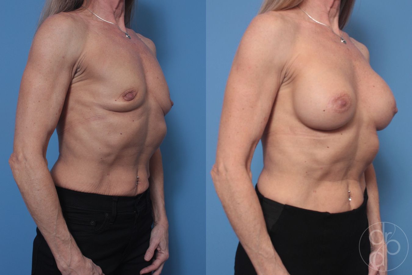 Before and after Breast Augmentation case 29925 - Angle 2