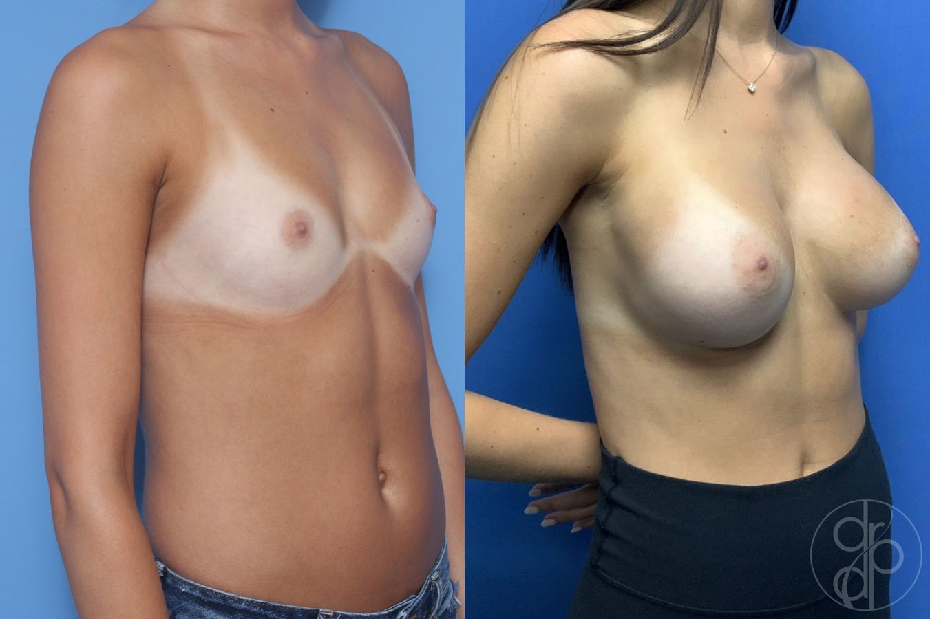 Before and after Breast Augmentation case 29974 - Angle 3